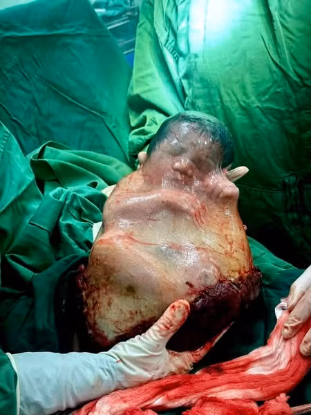 Em bé đầu năm sinh bọc điều với tỷ lệ hy hữu 1/80.000 ca ảnh 2