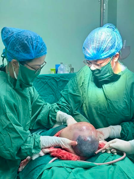 Em bé ra đời tự nhiên còn nguyên bọc điều - Ảnh BVCC