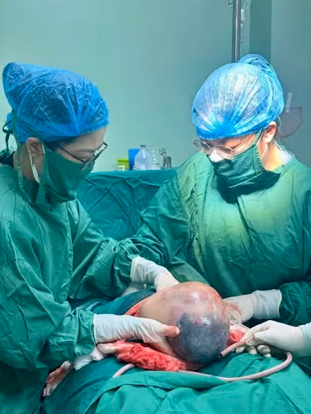 Em bé ra đời tự nhiên còn nguyên bọc điều - Ảnh BVCC