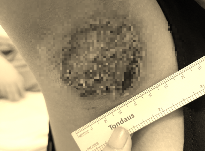 Nách hoại tử, cháy đen vì chữa hôi nách ở Spa ảnh 1