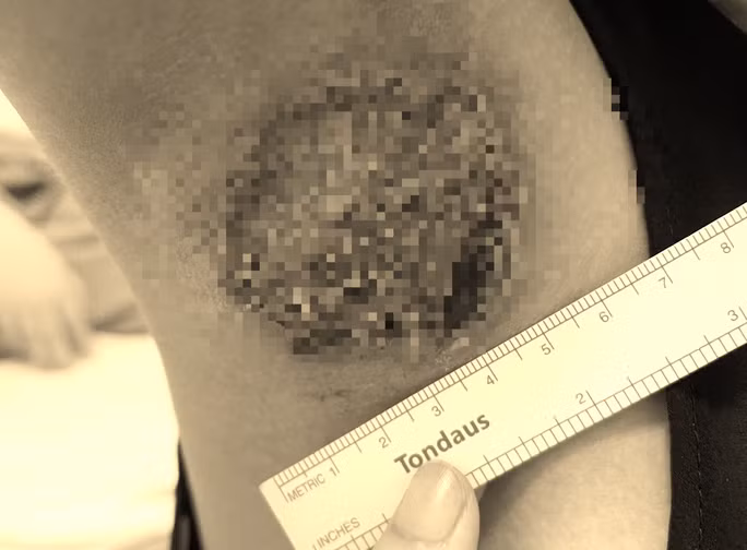 Nách hoại tử, cháy đen vì chữa hôi nách ở Spa ảnh 1