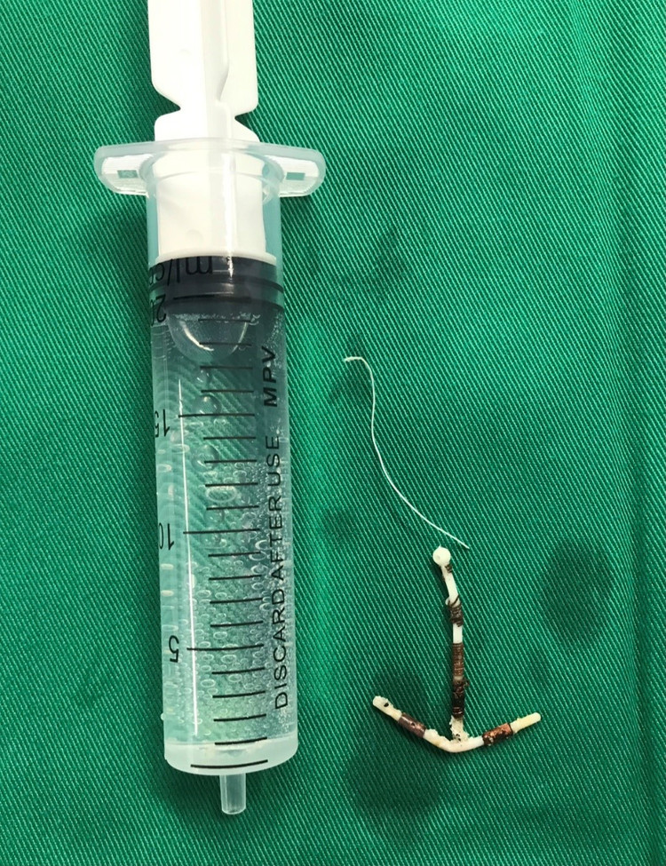 Chiếc vòng tránh thai được lấy ra