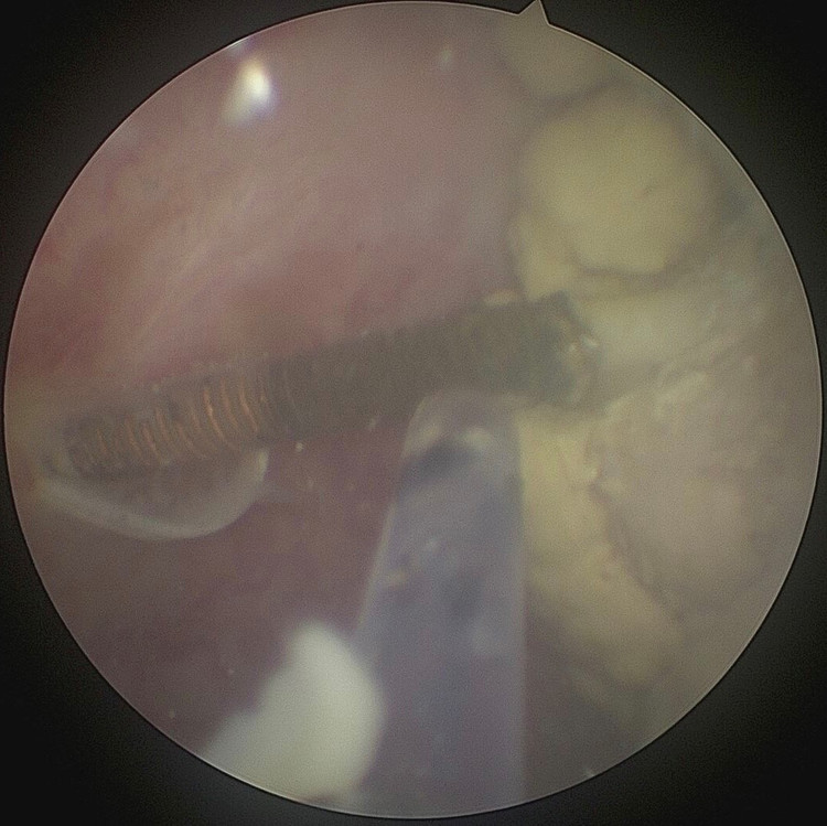 Lase phá sỏi bám quang vòng tránh thai