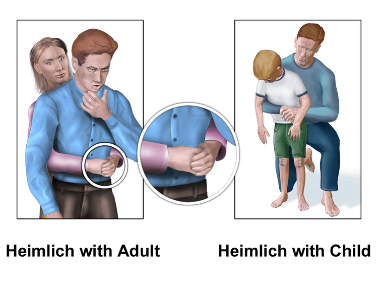 Nghiệm pháp Heimlich hỗ trợ đẩy dị vật đường thở - Ảnh minh họa