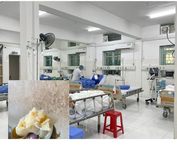 Bệnh nhân hôn mê do hóc dị vật bánh dày