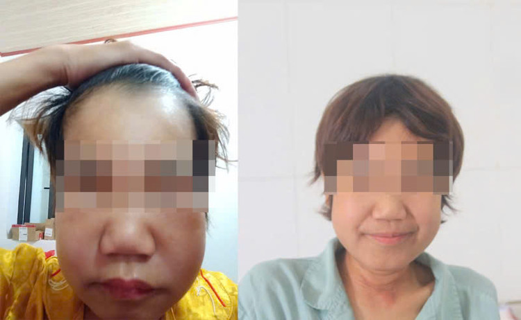 Bệnh nhân phù bạch huyết trước và sau điều trị - Ảnh BVCC