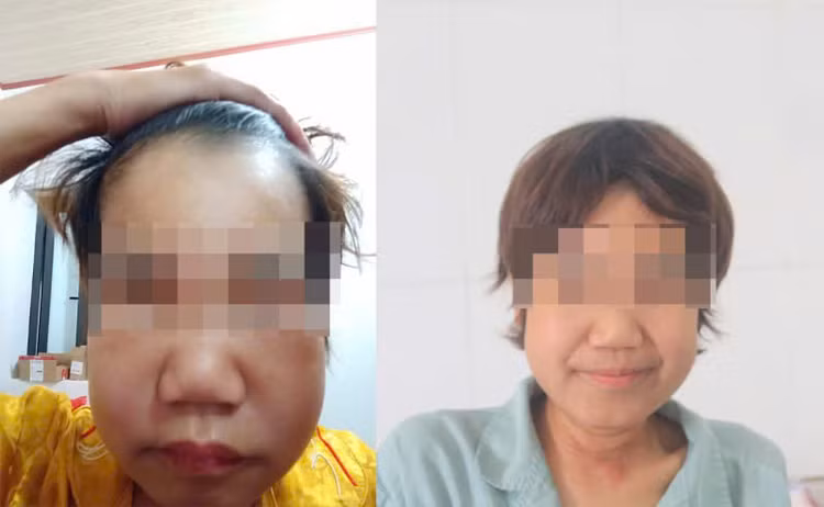 Bệnh nhân phù bạch huyết trước và sau điều trị - Ảnh BVCC