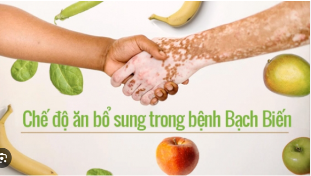 Chế độ ăn bổ sung có bằng chứng trong bệnh bạch biến ảnh 1