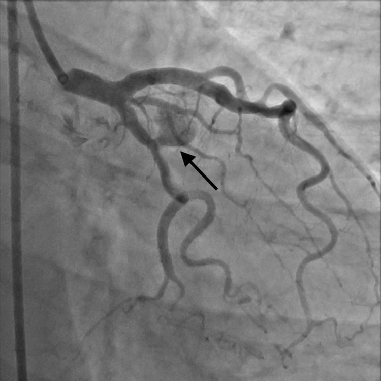 Túi giả phình động mạch trước can thiệp - Ảnh BVCC
