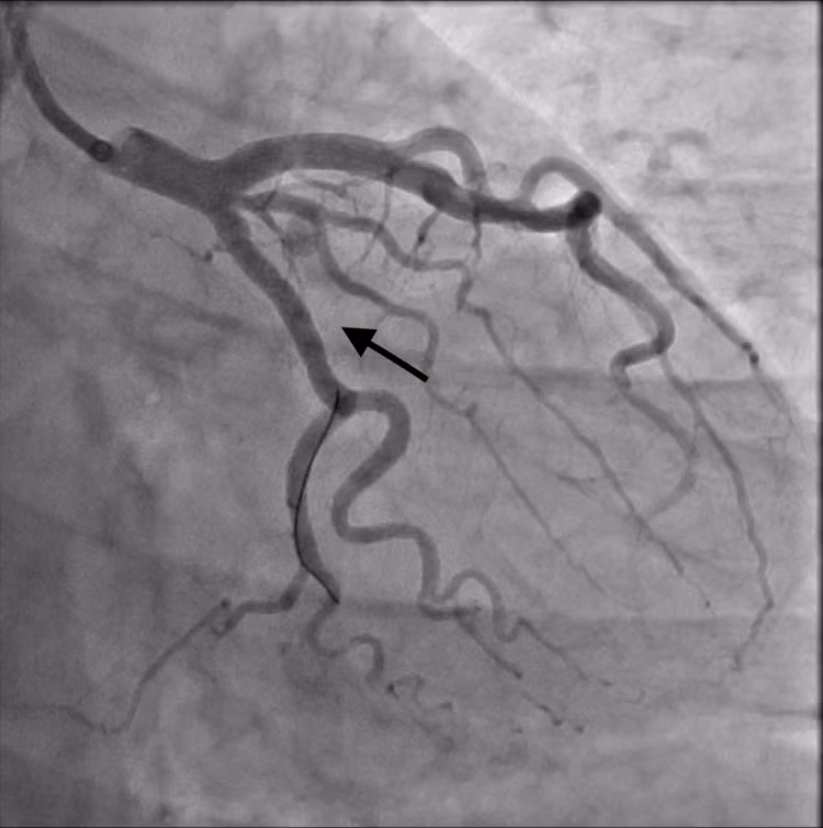 Túi giả phình động mạch sau can thiệp - Ảnh BVCC