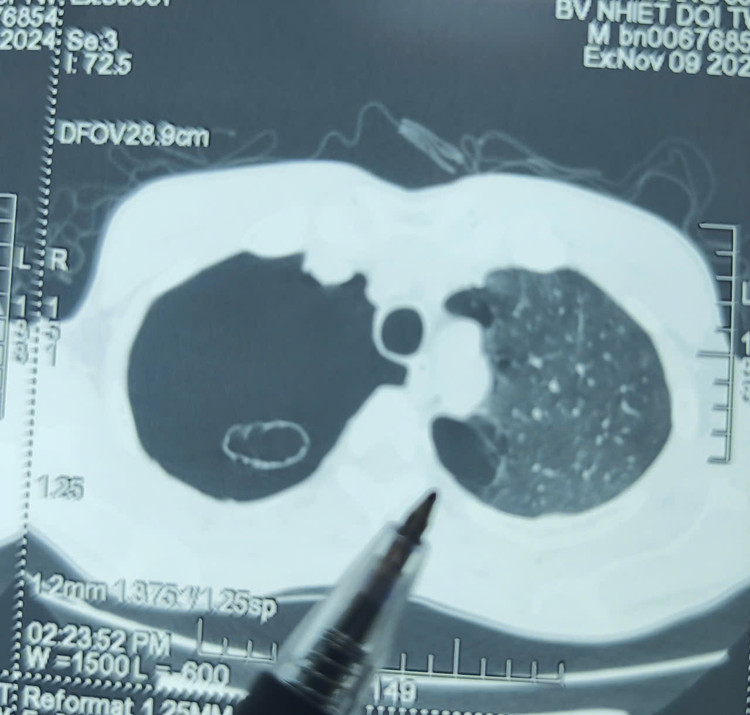 Hình ảnh tràn khí màng phổi trên phim chụp - Ảnh BVCC