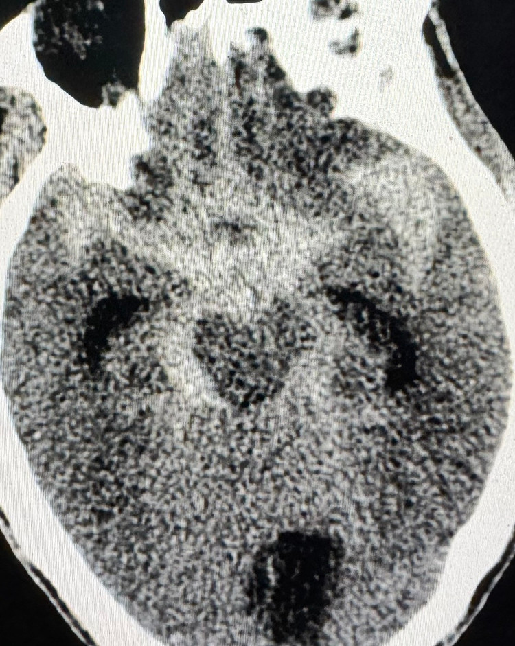 Vỡ túi phình đỉnh thân nền trên phim chụp - Ảnh BVCC