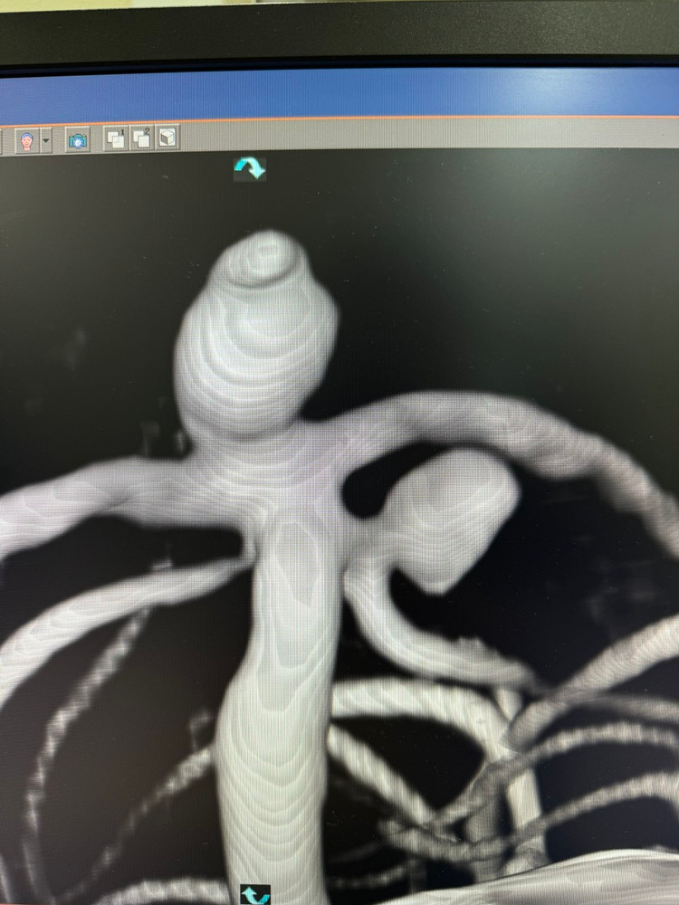 vòng xoáy kim loại nút tắc - Ảnh BVCC