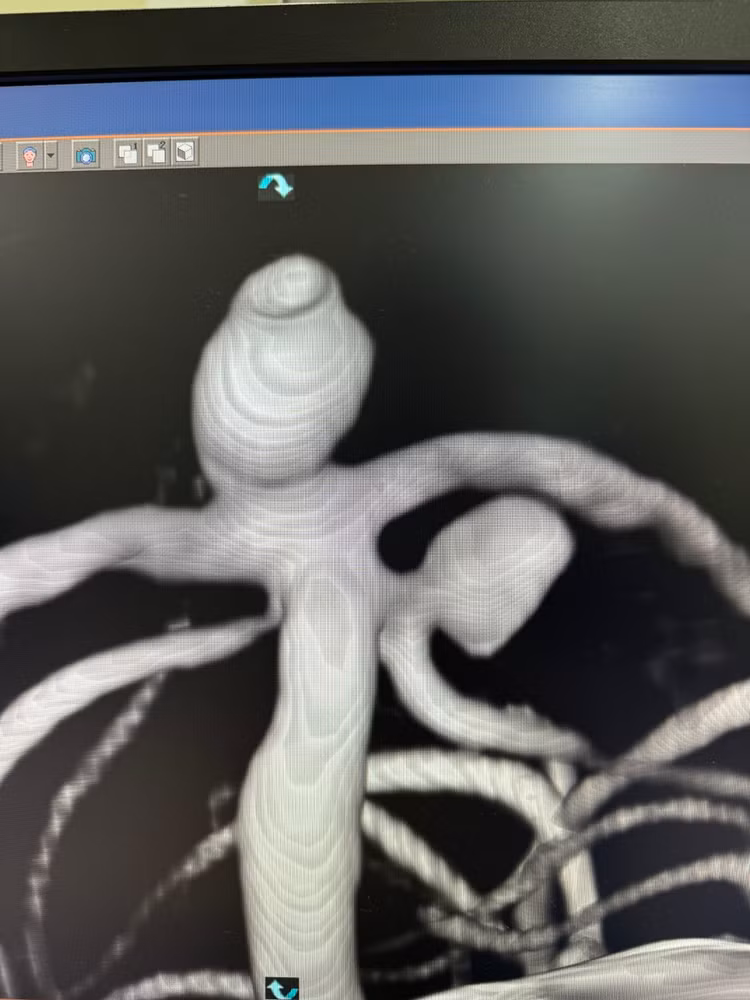 vòng xoáy kim loại nút tắc - Ảnh BVCC