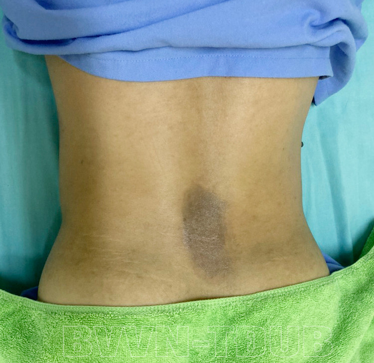 Vết bỏng ở vùng lưng của người bệnh sau gần 2 tuần điều trị tại bệnh viện - Ảnh: BVCC