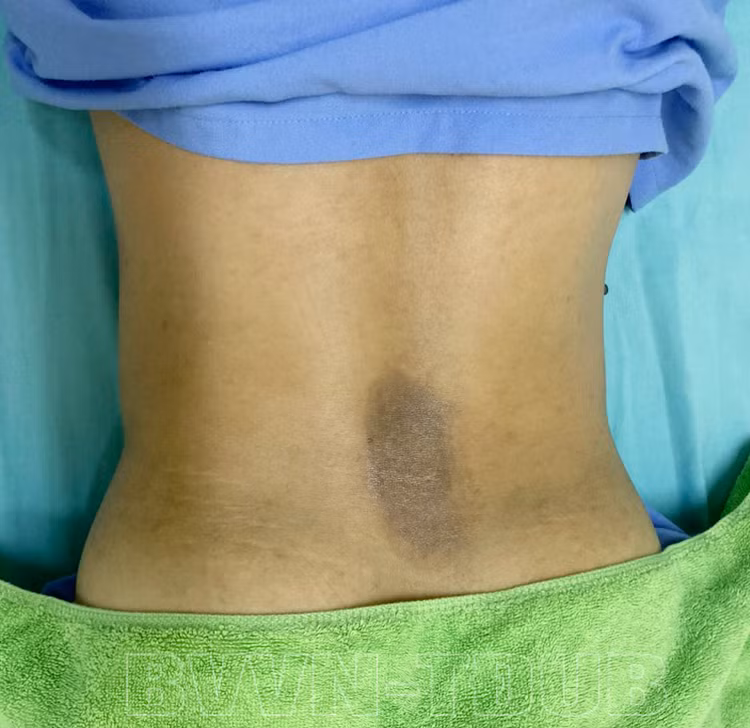 Vết bỏng ở vùng lưng của người bệnh sau gần 2 tuần điều trị tại bệnh viện - Ảnh: BVCC