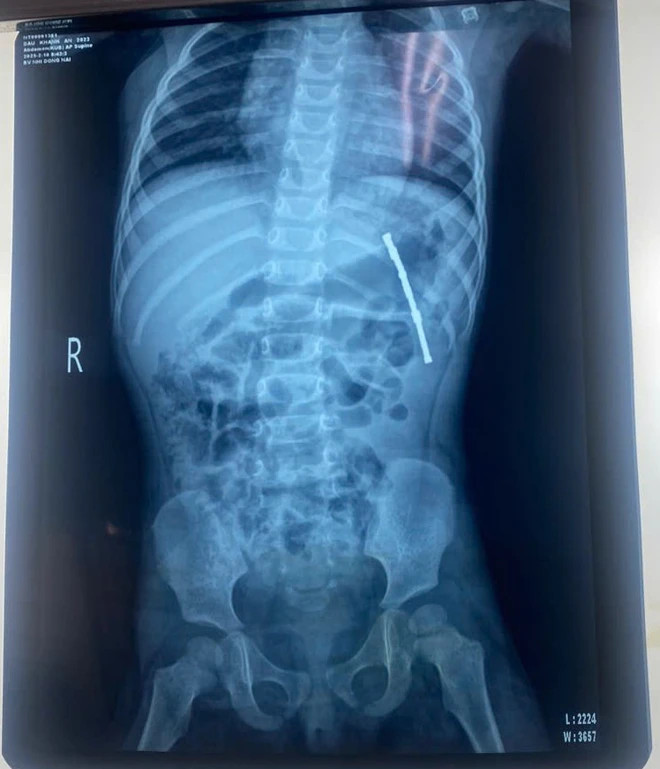 Dị vật nam châm trên phim chụp - Ảnh BVCC