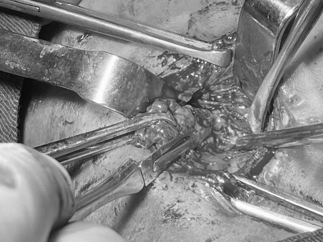 Ca phẫu thuật cho bệnh nhi tại Bệnh viện Tai mũi họng TƯ.