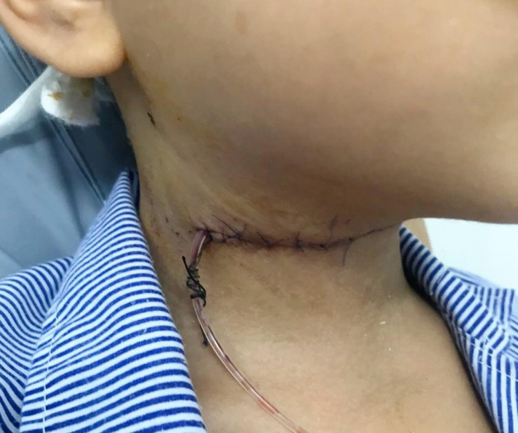 Bé V.T.S sau phẫu thuật.