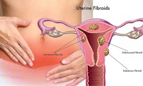 30% phụ nữ vô sinh do tắc vòi tử cung: Chị em phải làm gì? ảnh 1