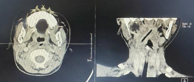 Phim chụp đũa gỗ trong cổ bệnh nhi