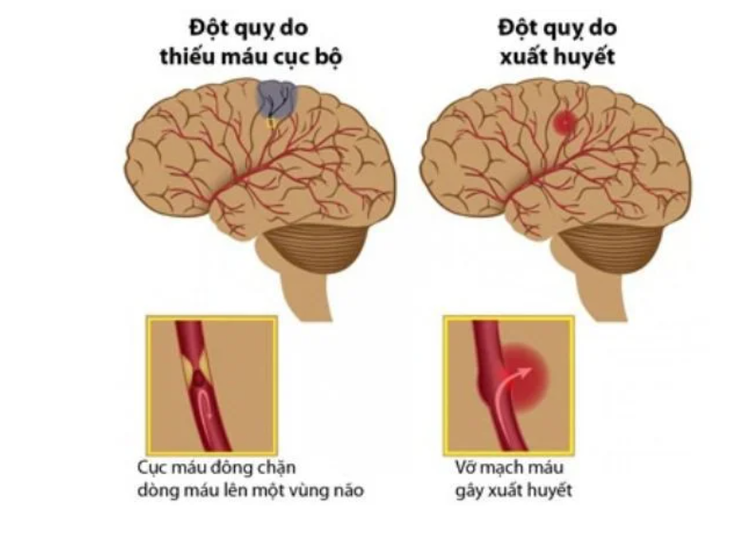 Nguyên nhân gây đột quỵ là do sự bất ổn của tuần hoàn máu não.