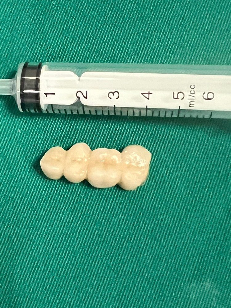 4 chiếc răng giả được lấy ra