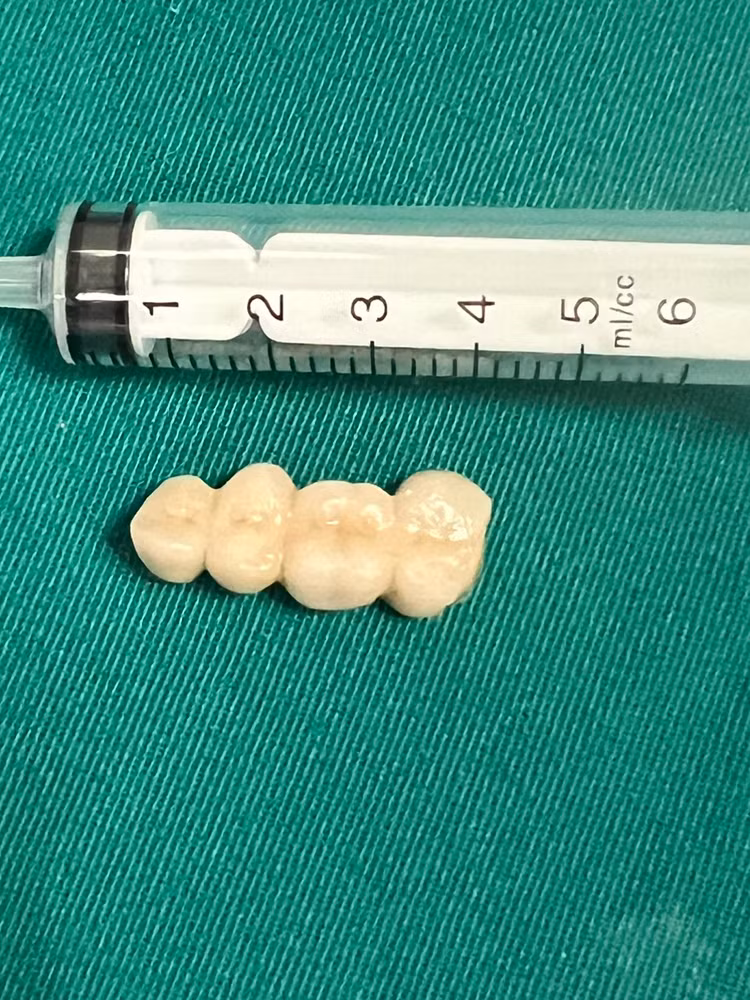 4 chiếc răng giả được lấy ra