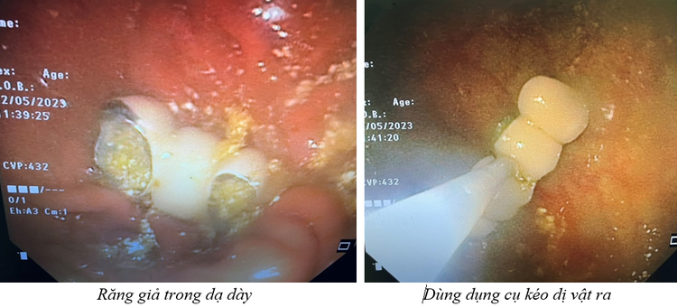 Dị vật răng giả rơi vào dạ dày bệnh nhân