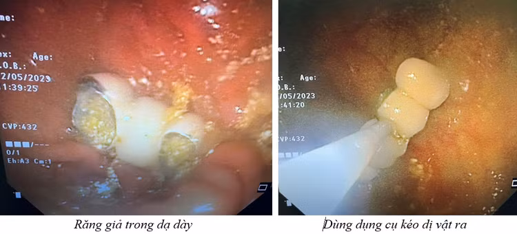 Dị vật răng giả rơi vào dạ dày bệnh nhân