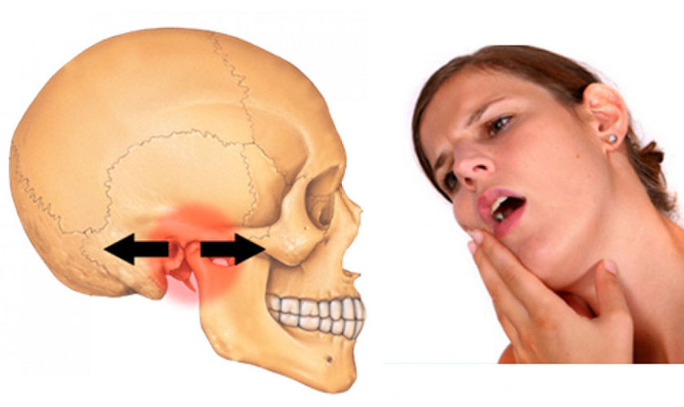 Viêm khớp thái dương hàm - Ảnh minh họa