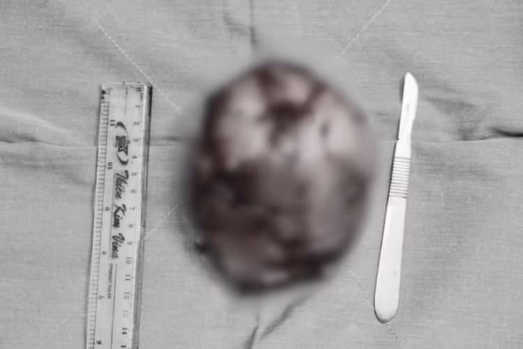 Hình ảnh khối u sau phẫu thuật - Ảnh BVCC