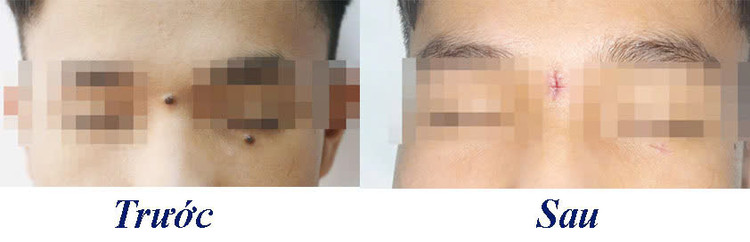 Hình ảnh bệnh nhân trước và sau phẫu thuật loại bỏ nốt ruồi - Ảnh BVCC