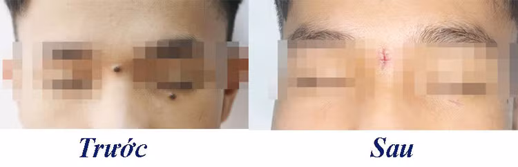 Hình ảnh bệnh nhân trước và sau phẫu thuật loại bỏ nốt ruồi - Ảnh BVCC