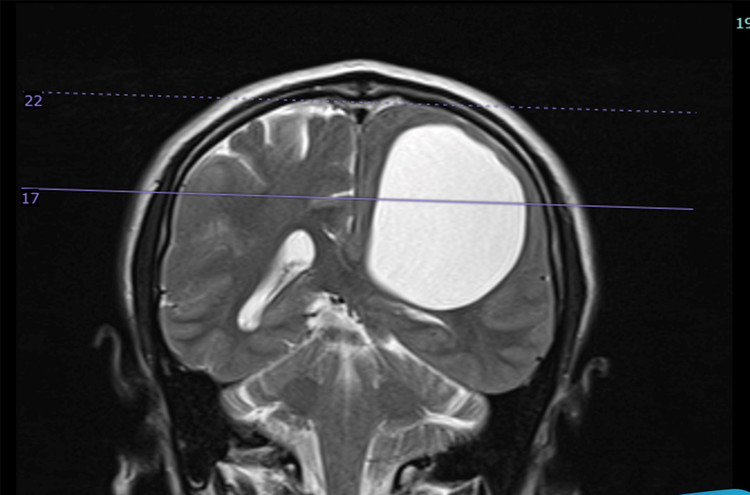 Ảnh MRI trước mổ của bệnh nhân liệt nửa người: Nang sán lớn nhất nằm trong nhu mô bán cầu não bên trái