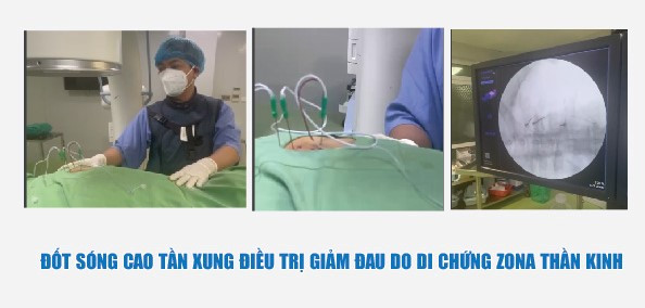 Hình ảnh kim đốt được TS.BS Vi Trường Sơn – Trưởng khoa Ngoại yêu cầu đưa vào vị trí liên sườn của người bệnh