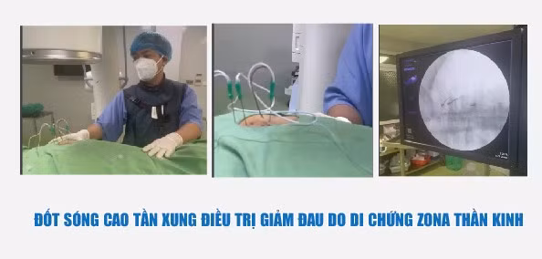 Hình ảnh kim đốt được TS.BS Vi Trường Sơn – Trưởng khoa Ngoại yêu cầu đưa vào vị trí liên sườn của người bệnh