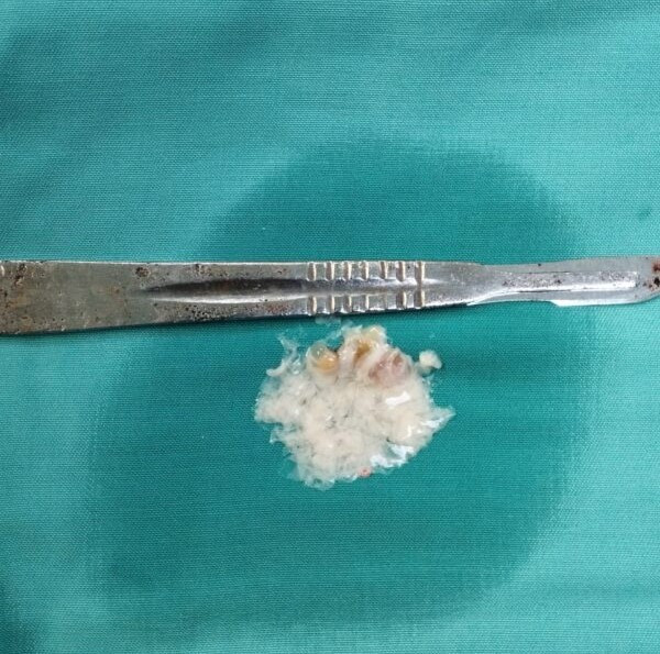 Nang sán não được lấy ra