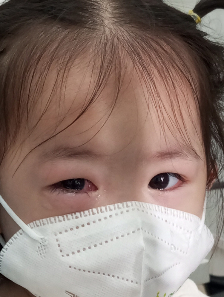 Trẻ đau mắt đỏ dễ biến chứng nặng Trẻ đau mắt đỏ dễ biến chứng nặng