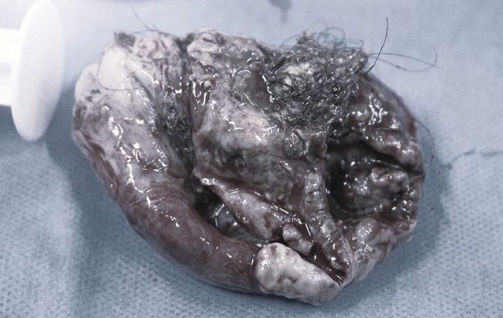 U buồng trứng quái vật được lấy ra