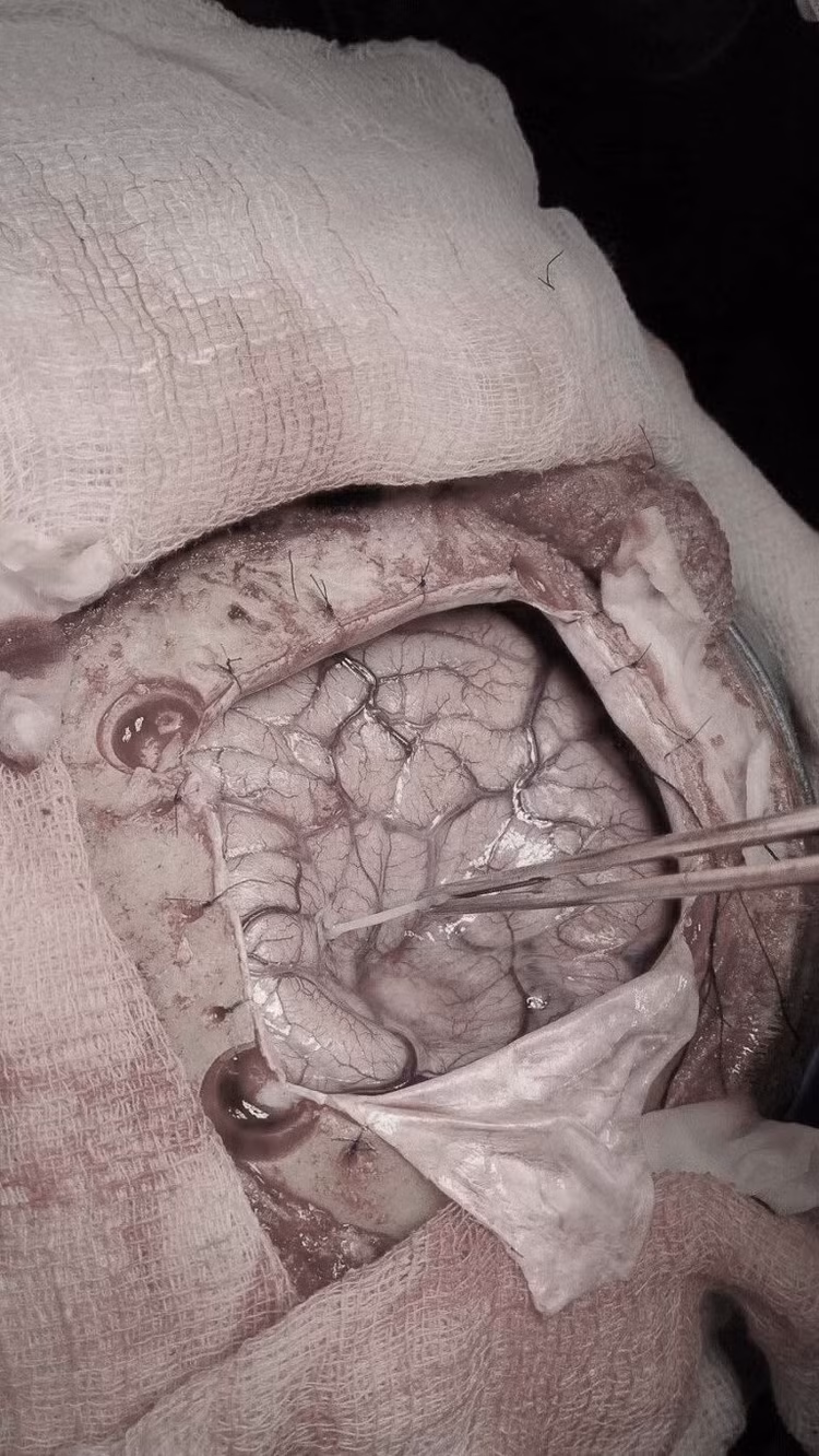 Phẫu thuật lấy nang sán từ trong não