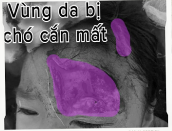 Ngồi chơi trước nhà bé 5 tuổi bị chó cắn rách mặt nặng nề ảnh 1 Ngồi chơi trước nhà bé 5 tuổi bị chó cắn rách mặt nặng nề ảnh 1