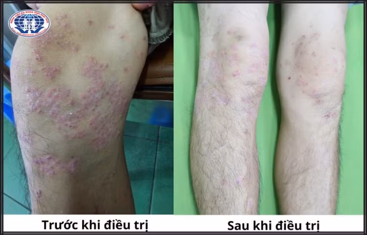 Khớp chân của người bệnh viêm khớp vảy nến trước và sau khi điều trị