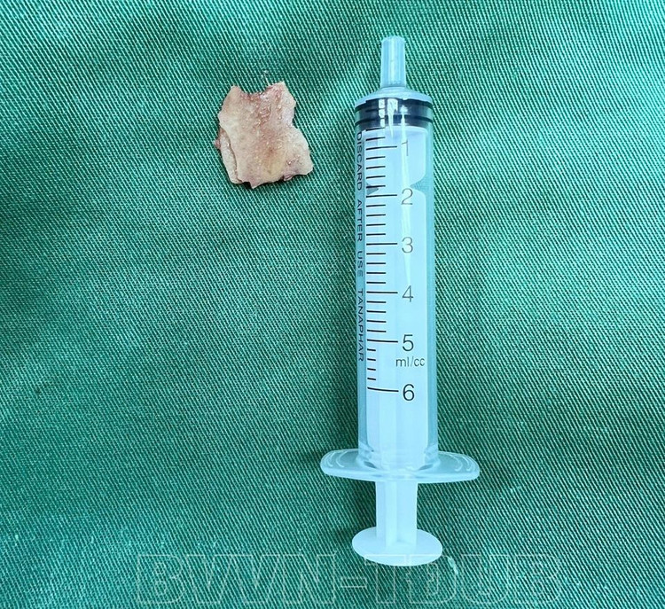 Ho ra máu phát hiện xương lợn hóc mắc kẹt trong phế quản cả năm ảnh 1