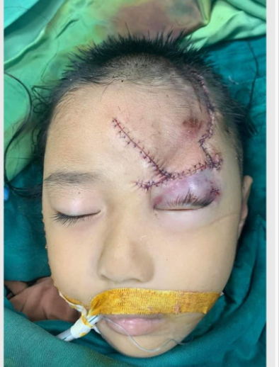 Tổn thương của trẻ sau phẫu thuật tạo hình Tổn thương của trẻ sau phẫu thuật tạo hình