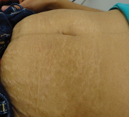 Rạn da màu trắng ở bụng