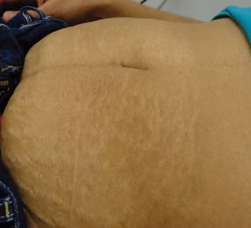 Rạn da màu trắng ở bụng