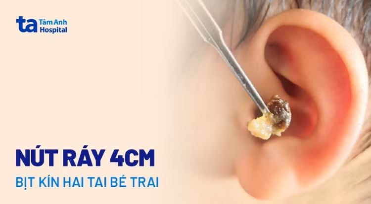 Hình ảnh ráy tai đông đặc một bên tai (hình A) và ống tai sạch sẽ sau khi được bác sĩ vệ sinh - Ảnh BVCC