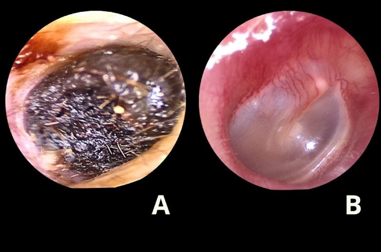 Ráy tai dài 4 cm đông đặc bịt kín tai trẻ khiến nghe kém Ráy tai dài 4 cm đông đặc bịt kín tai trẻ khiến nghe kém