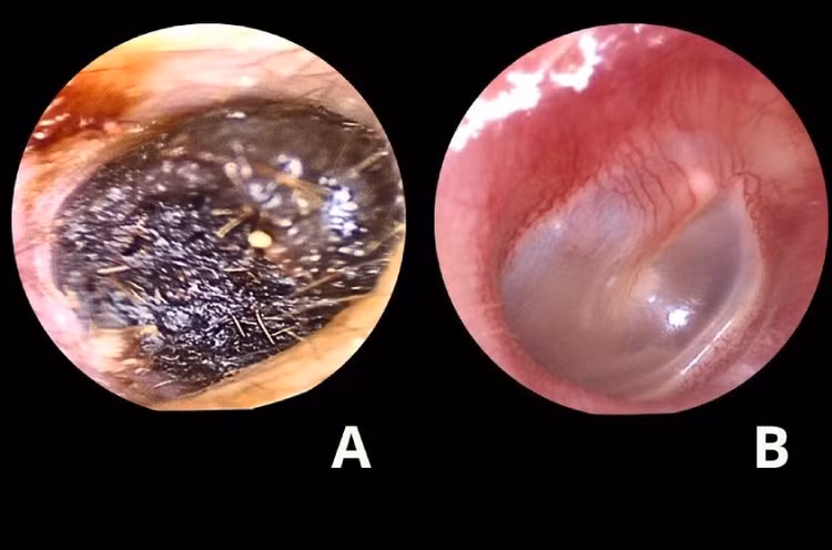Ráy tai dài 4 cm đông đặc bịt kín tai trẻ khiến nghe kém